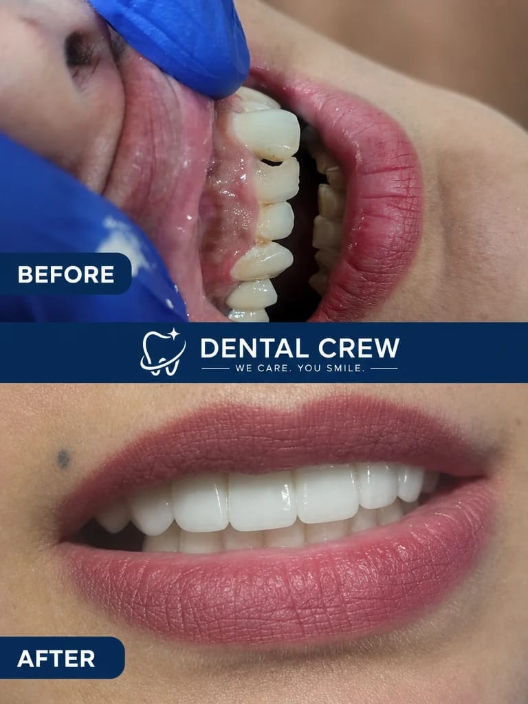 Cosmetic Veneers & Rehabilitation Before After