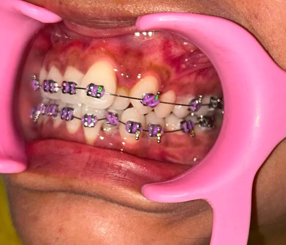 Clinical Bite Correction Procedure