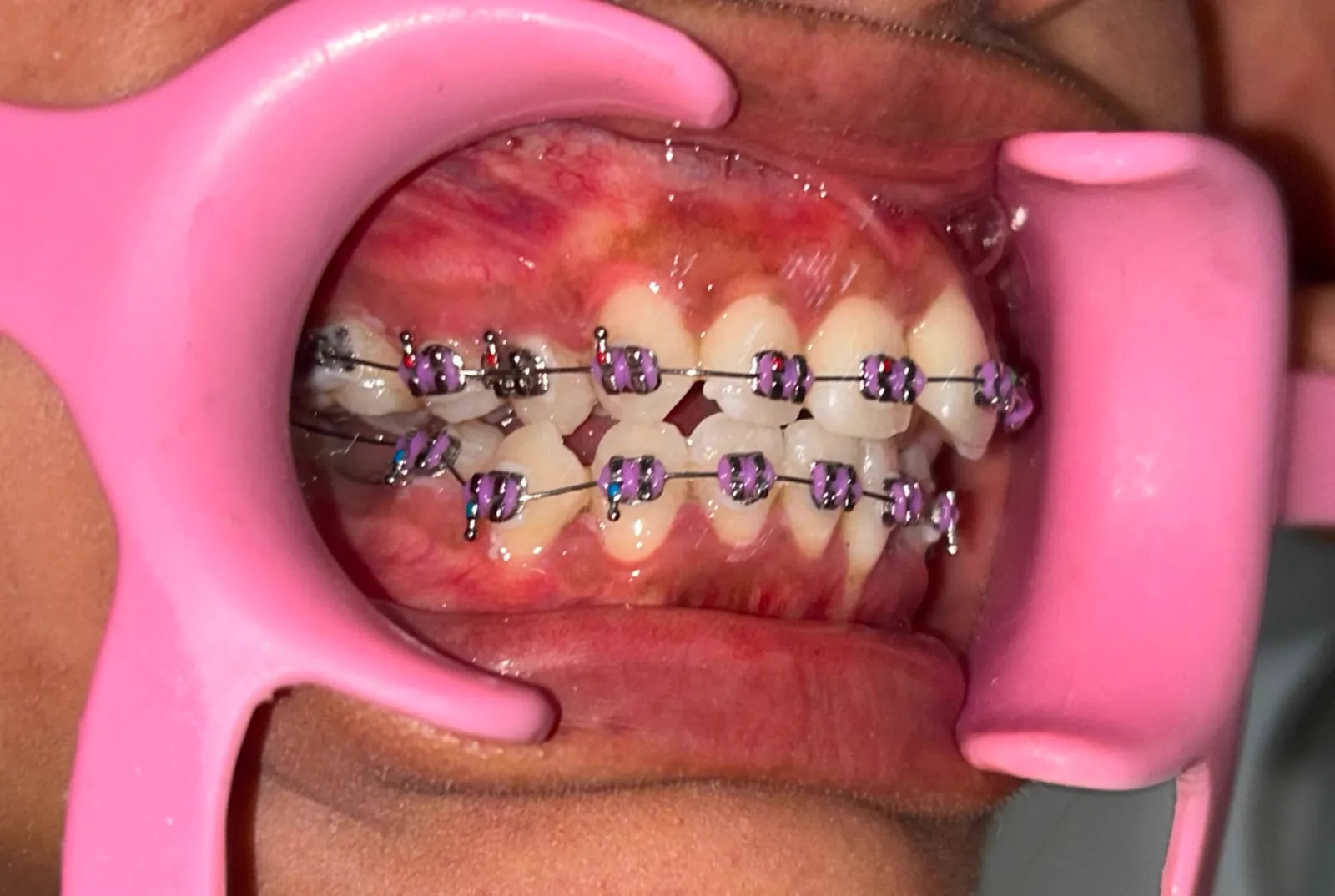 3D Guided Orthodontic Alignment