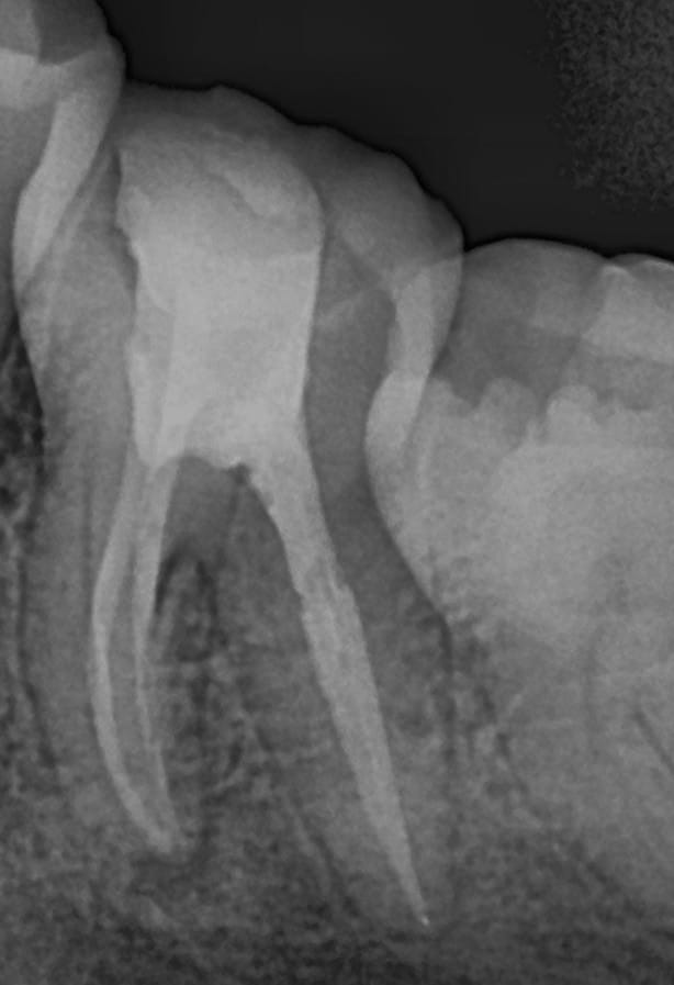 Digital Dental X-Ray Root Canal Treatment Obturation Radiograph
